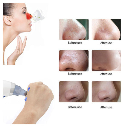 Derma black head suction tool
